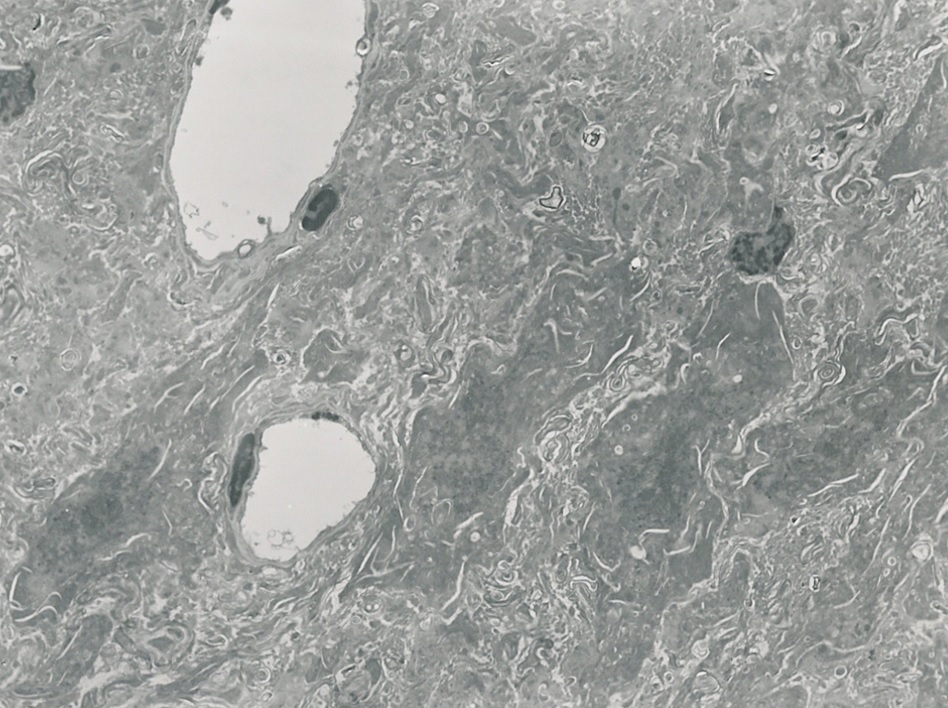 Electron micrograph of M22-shrunken brain tissue from 21st Century Medicine