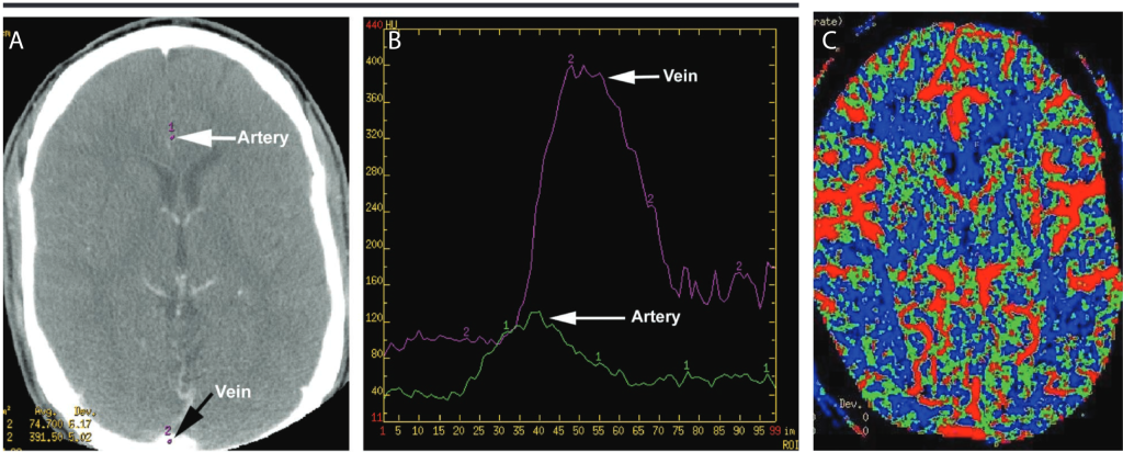 CT perfusion imaging of a healthy human brain